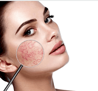 Сосуды, купероз, гемангиомы