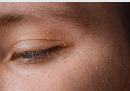 Папилломы, бородавки