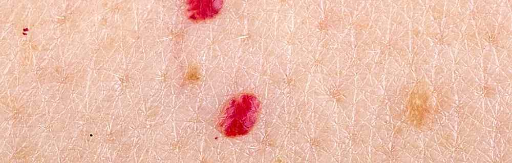 Красная родинка. Ангиома