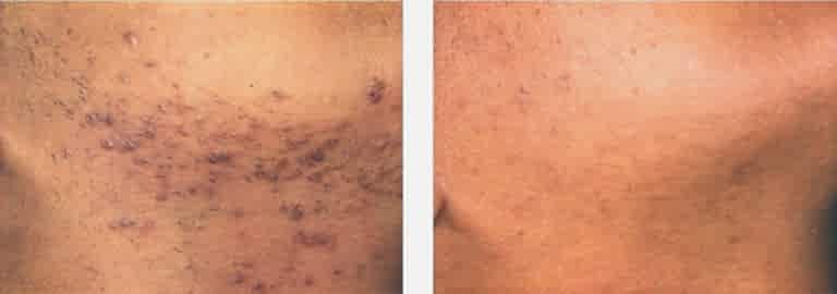 Вросшие волосы