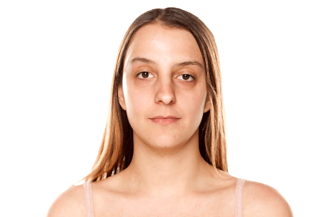 Лицо "Обвисло" после похудения