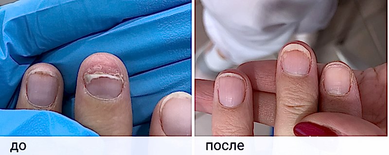 грибок ногтей.jpg