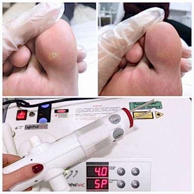 Удалени бородавок на ногах.jpg