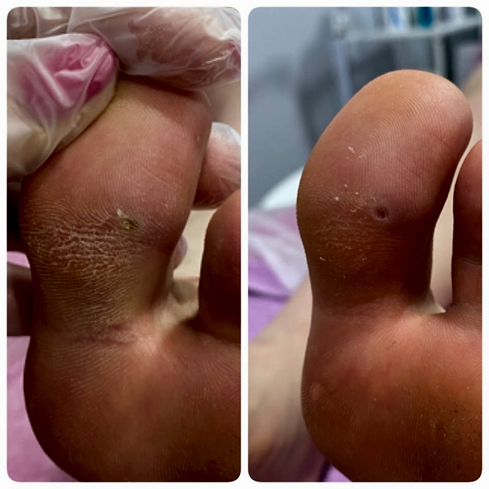 Стержневая мозоль