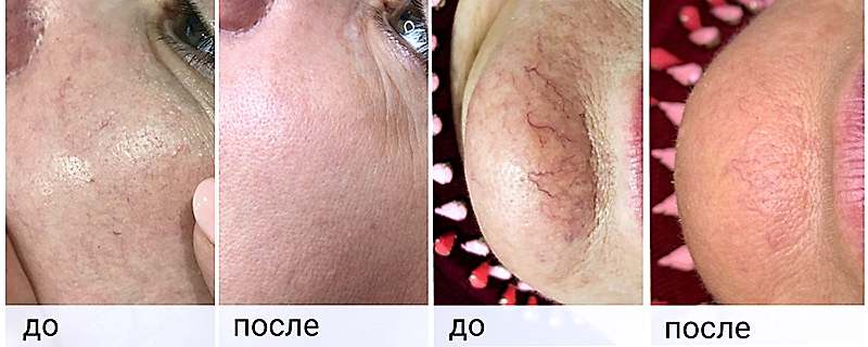 сосуды на лице.jpg