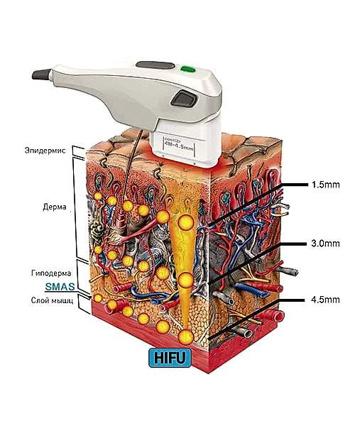 СМАС лифтинг Санте Эстетик.jpg