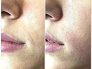 Носогубные складки