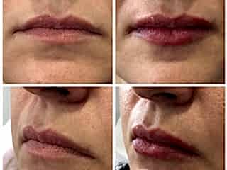 Коррекция губ.jpg