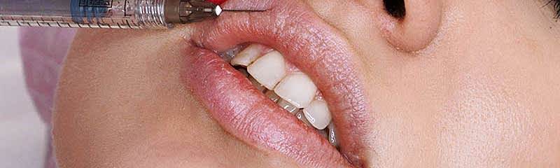 Удаление гиалуронового филлера