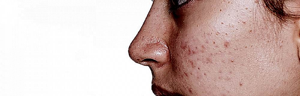 Лечение акне