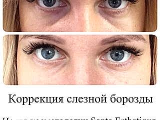 слезная борозда.jpg