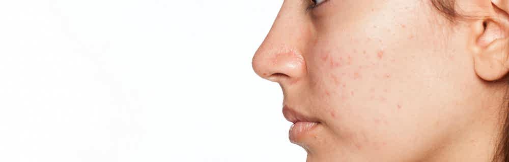 Карбокситерапия, лечение кожи