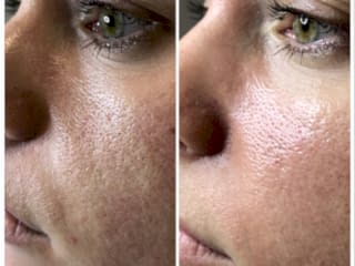 Коррекция скул