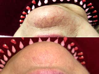 Удаление сосудов на лице