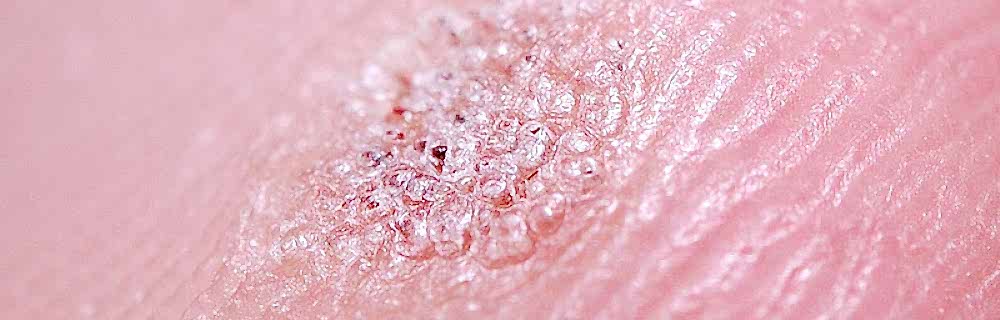 Удаление бородавок / шипиц