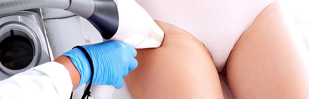 Лазерная эпиляция