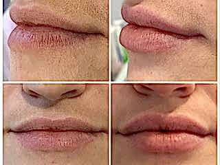 Омоложение губ