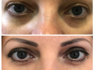 Синяки под глазами