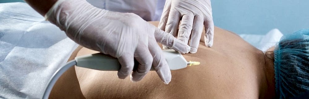 Карбокситерапия инъекционная